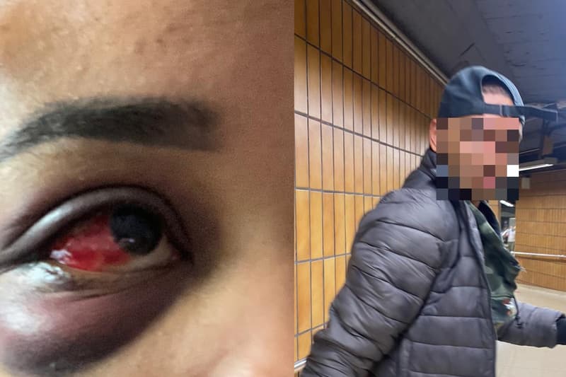 El ojo de Paloma después de la agresión y el presunto ladrón que la agredió
