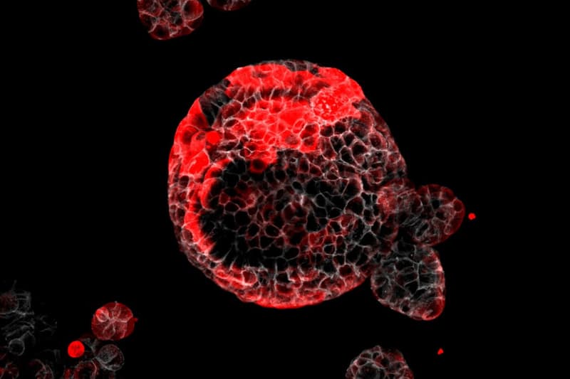 Organoide de càncer colorectal amb cèl·lules residuals responsables de la recaiguda marcades en vermell