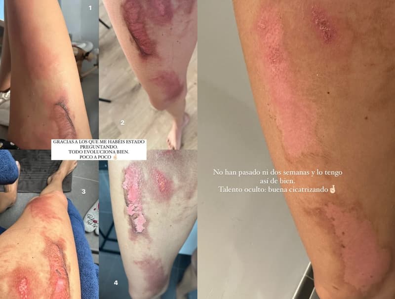 Les ferides de Lidia Torrent després de l'accident | Instagram