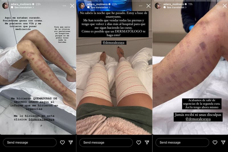 Adara Molinero mostra les cremades a les cames | Instagram